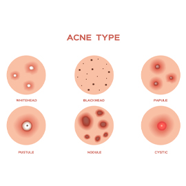 Types of Acne